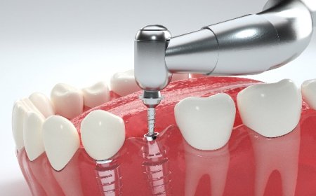 Dental Implants: Your Path to a Radiant Smile