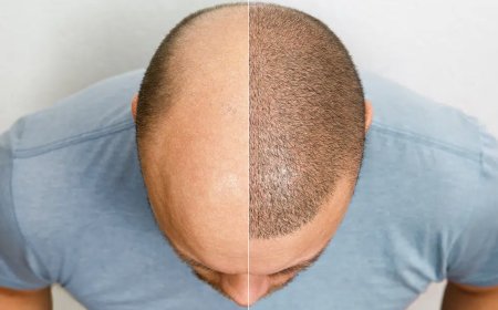Understanding Hair Transplantation: A Comprehensive Guide