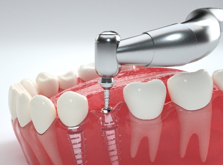 Dental Implants: Your Path to a Radiant Smile