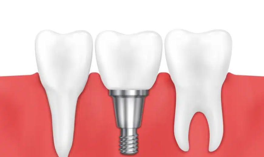 Dental Implants: Key Insights and Considerations