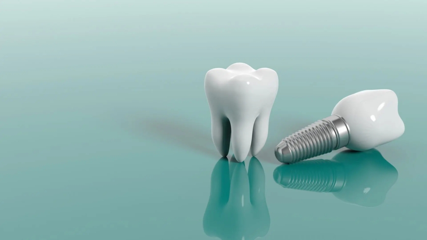 Proper Care for Dental Implants: A Guide