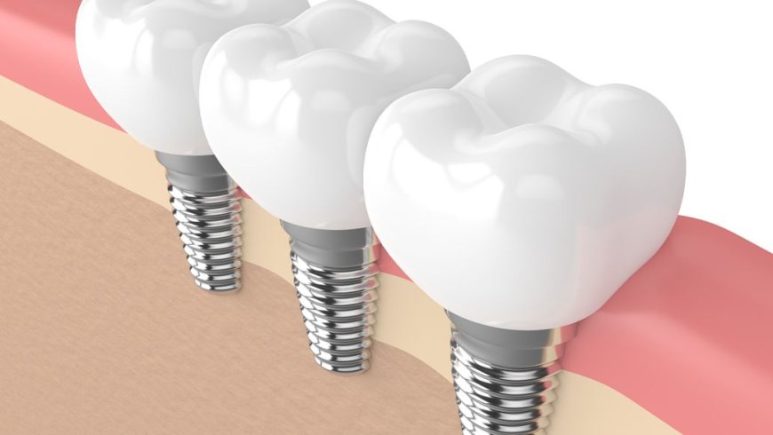 Dental Implants: What and How