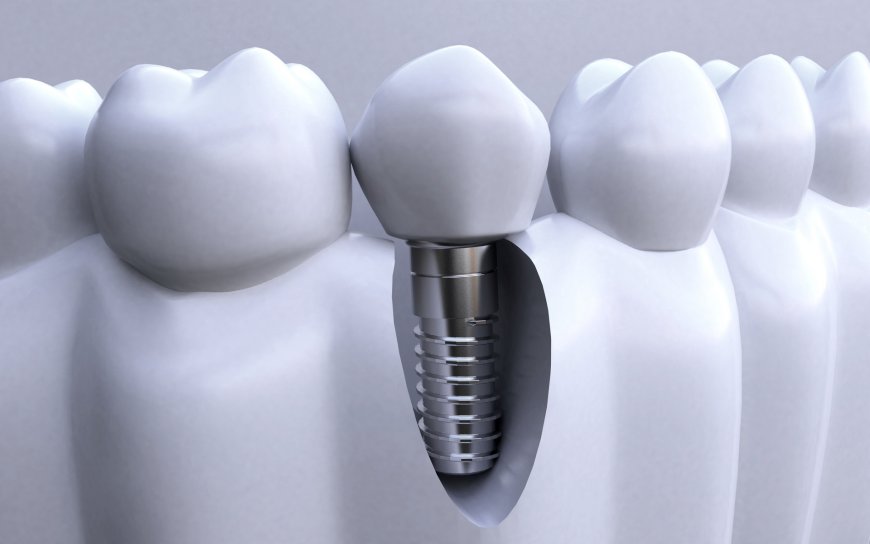 Dental Implant: What You Must Know