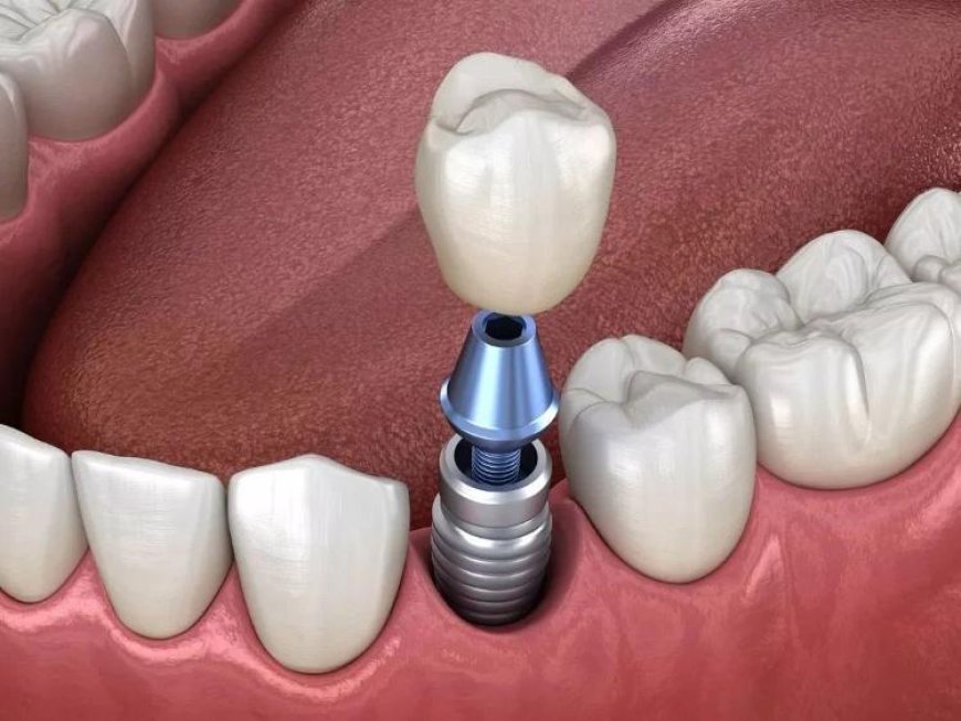 Dental Implant Surgery: Criteria, Contraindications, and Process