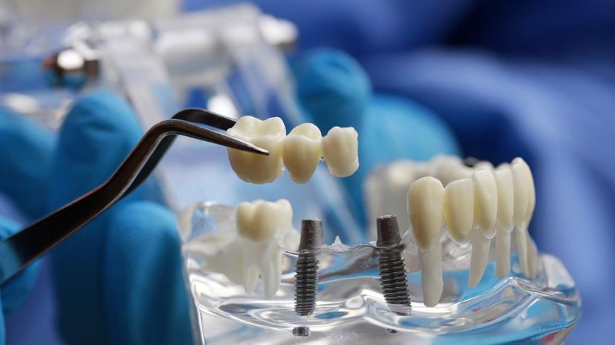 The Benefits and Drawbacks of Dental Implants