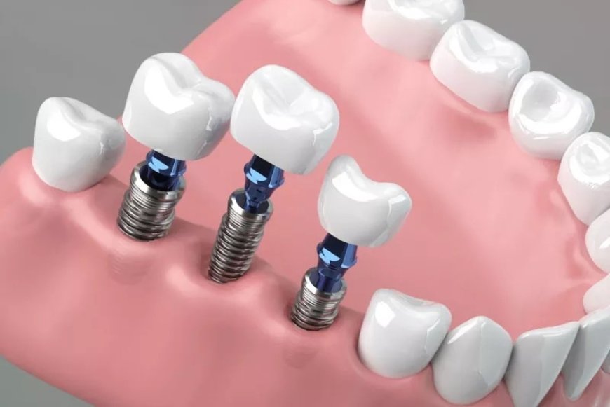 Seniors Can Now Get Affordable Teeth Replaced Service